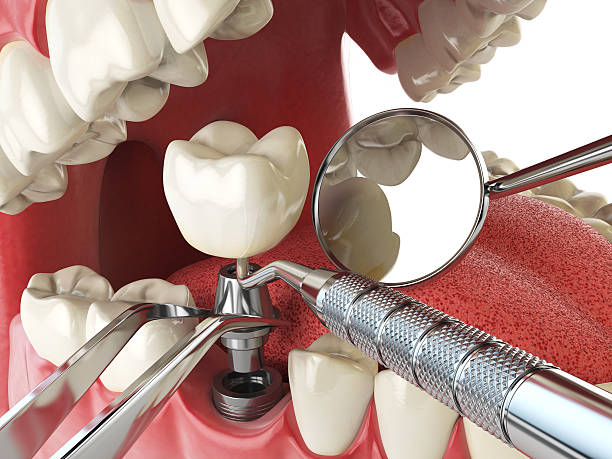 Best Chipped Tooth Repair Near Me  in Tahoma, CA